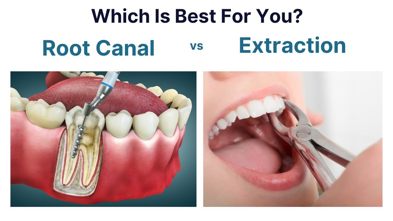 root canal vs extraction